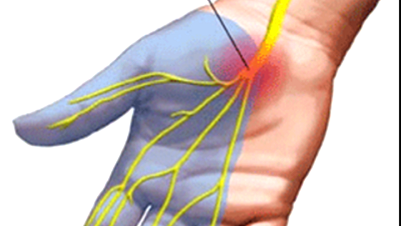 Χαράλαμπος Ντινόπουλος: Το σύνδρομο καρπιαίου σωλήνα πλήττει έως και το 5% του πληθυσμού, κυρίως γυναίκες